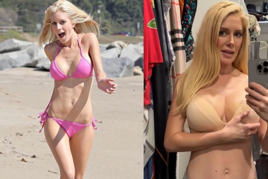 Heidi Montag plastic surgery before and after